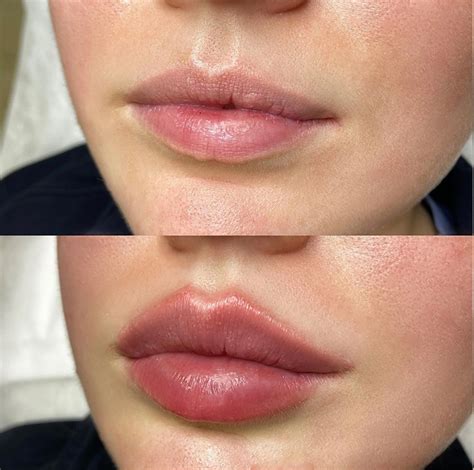 Lip Filler Harley Street London - Get The Perfect Pout