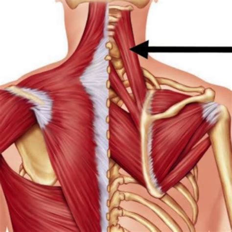 Trigger Point Therapy - Levator Scapulae Taping Procedure | Levator Scapulae, Shoulder, Taping ...