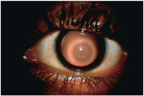 Rizzuti Sign Keratoconus