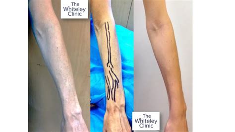 Arm Veins Removal – The Whiteley Clinic