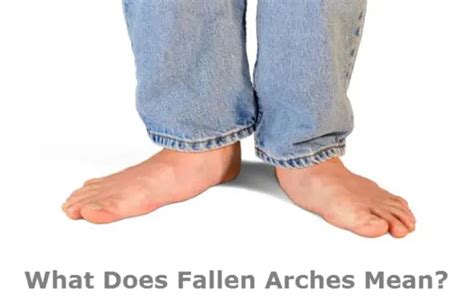 What Does Fallen Arches Mean?