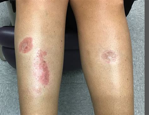 A woman with a history of diabetes, and plaques on both shins | MDedge ...