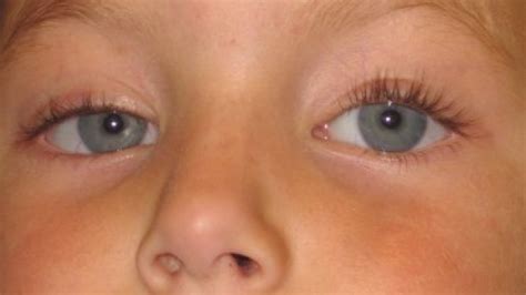 congenital ptosis| eyelid and orbital disorders