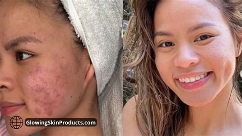 Acne marks pigmentation problems get away with vitamin C serum