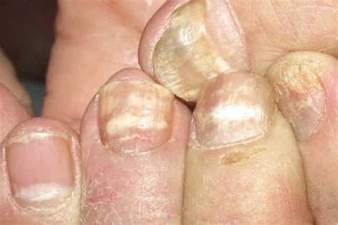 White Spots on Fingernails, Dots, Patches, Pictures, Causes, Get Rid, Treatment & Home Remedies