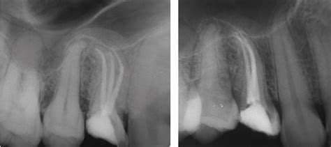 Modern instrumentation addresses tooth with three root canals