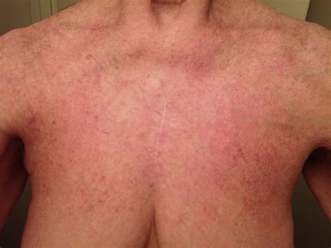 Lupus Rash On Neck And Chest
