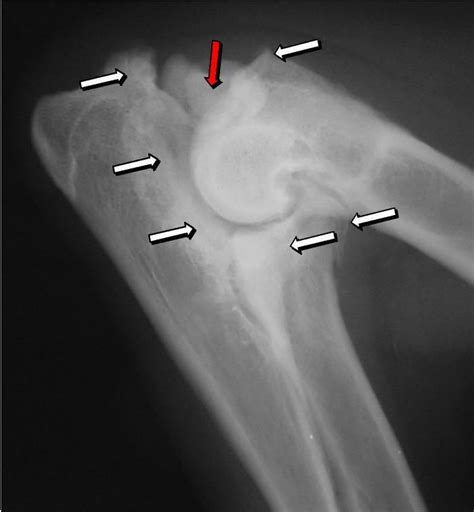 Elbow dysplasia - Alchetron, The Free Social Encyclopedia