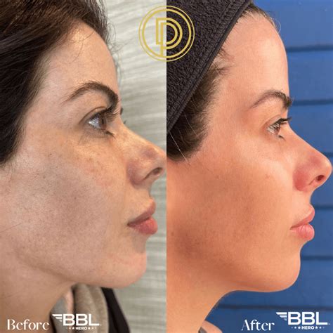 Bbl Light Treatment Before And After Shelly Lighting - vrogue.co