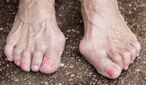 Hammertoe - Symptoms, Causes, Relief And Treatments