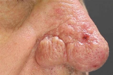 Rhinophyma Treatment | Brisbane Skin Has Solutions