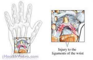 Wrist Sprain Treatment in India