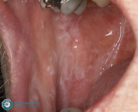 Lichen Planus Mouth Lesions