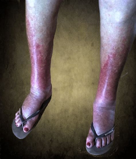 Cutaneous purpuric rash and edema of the ankles and feet (case courtesy... | Download Scientific ...