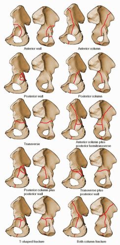 Acetabular Fractures: The Kocher-Langenbeck Approach | Musculoskeletal Key