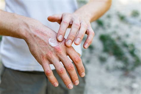 Hand Dermatitis: Understanding, Preventing, & Treating Dry Skin - Apex ...