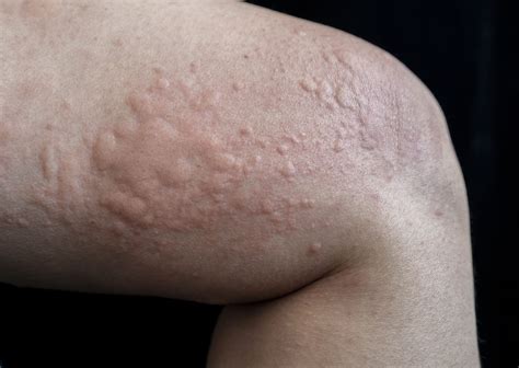 Hives Treatment In Singapore | By Dr Lee Hwee Chyen