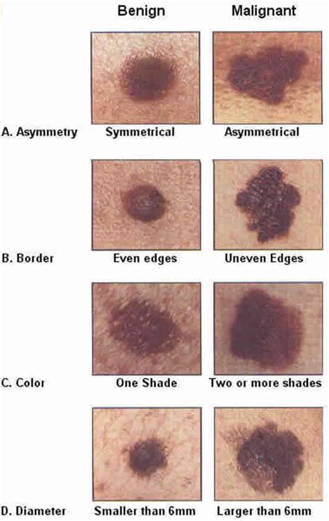 Cancerous Mole Vs Normal Mole