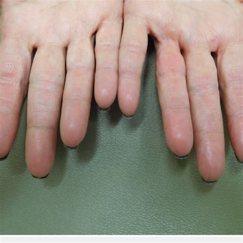 (PDF) Capecitabine-Associated Loss of Fingerprints: Report of Capecitabine-Induced ...