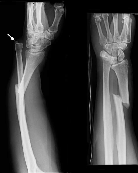 Galeazzi fracture - Wikiwand