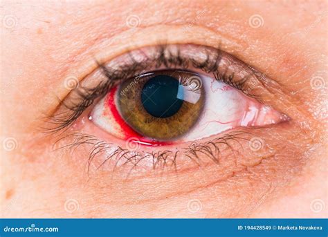 Detalle Del Ojo Marrón Femenino Con Daño Y Sangre En El Ojo Imagen de archivo - Imagen de rojo ...