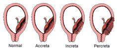 Placenta Accreta