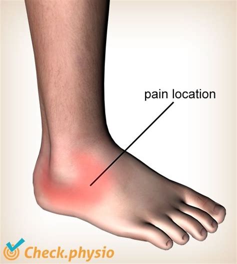 Lateral ankle ligament injury | Physio Check | Ligament injury, Ankle fracture, Ankle ligament ...