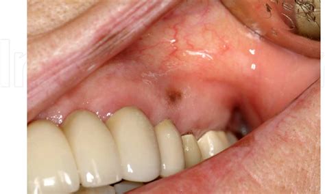 Figure 2 from Oral Malignant Melanoma | Semantic Scholar