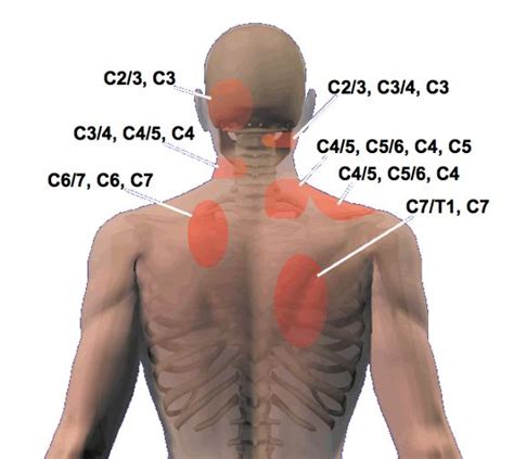 on subtle but not nerve pain in cervical spine nerve pain in | Health ...