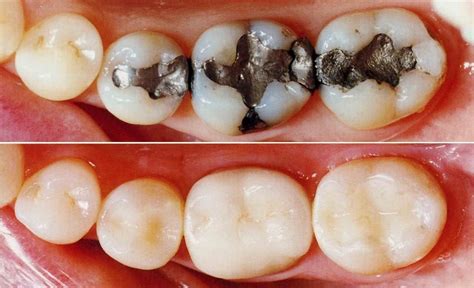 Tooth Cement Filling Cost In India at Lisa Gonsales blog