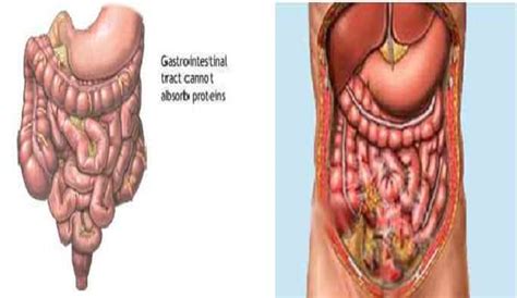 Gastrointestinal Perforation and Peritonitis Treatment in Kazimabad