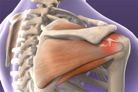 Shoulder Tendinopathy - Madrid Health | Chiropractor in Madrid