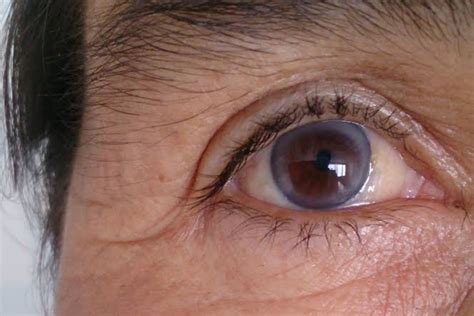 Cogan's Syndrome: Ghostly White Ring in the Cornea - The Eye News