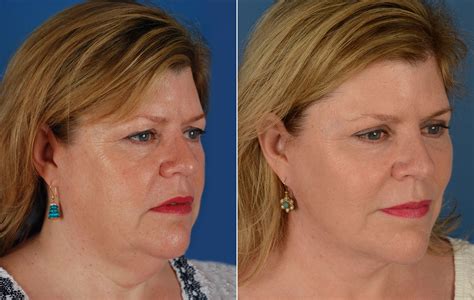 The UpLift™ Lower Face and Neck Lift Photos | Naples, FL | Patient 11683