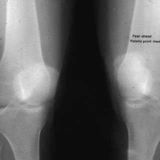 Example of a patient with squinting patella due to excess of tibial... | Download Scientific Diagram