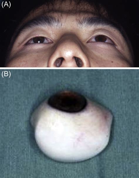 Secondary reconstruction of a mobile eye socket 30 years after ...