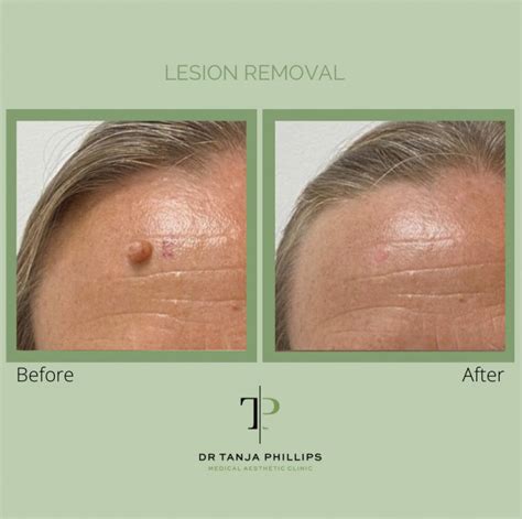 Your Ultimate Guide to Common Benign Skin Lesions | Skinfluencer