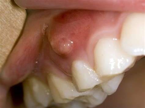 Infection In Gums Tooth at Anna Fermin blog