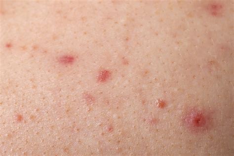 Butt Acne: What It Is, Causes & Treatment Options Available