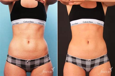 CoolSculpting Reviews: Before and After, Cost, Pros and Cons