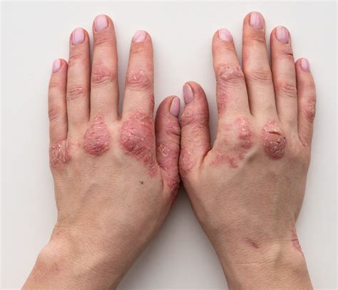 Psoriasis Triggers and Treatments | Durban Skin Doctor