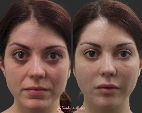 Smile Line Fillers - Before & After Results at Skinly