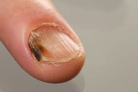 Nail fungus – symptoms, treatment, home remedies. Is laser mycosis ...