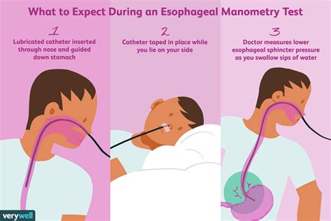 Test de manométrie oesophagienne : Utilisations, effets secondaires ...