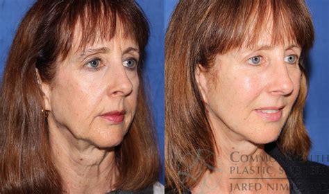 Facelift, facial fat grafting