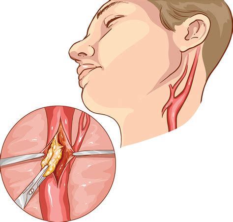 What is a Carotid Endarterectomy?
