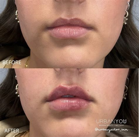 Lip Flips: What to Expect, Before & After Photos, and More — Urban You ...