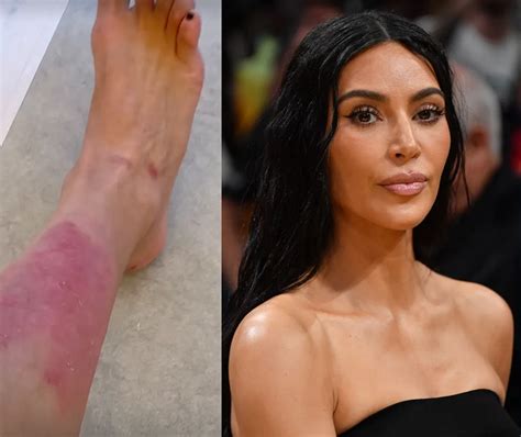 Kim Kardashian Opens Up About Painful Psoriasis Flare-Up and Treatment - Luvmp