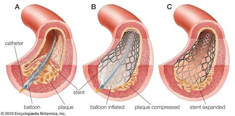 Atherosclerotic plaque | pathology | Britannica