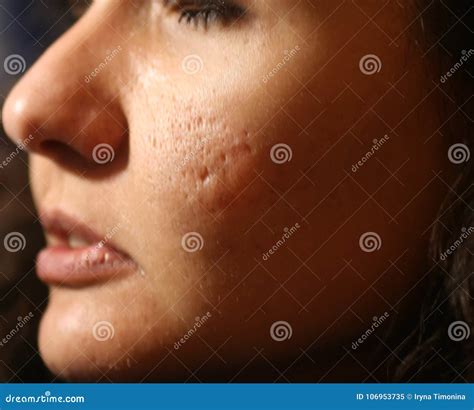 Inflamed Skin of the Face in Pimples and Acne. Keloid Scars from Acne Stock Image - Image of ...